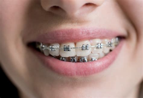 precios brackets metalicos|cuanto cuestan los brackets.